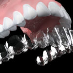 大人の歯科矯正～メリット・デメリットは？～