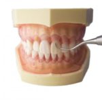 歯石はどうやって除去するの?